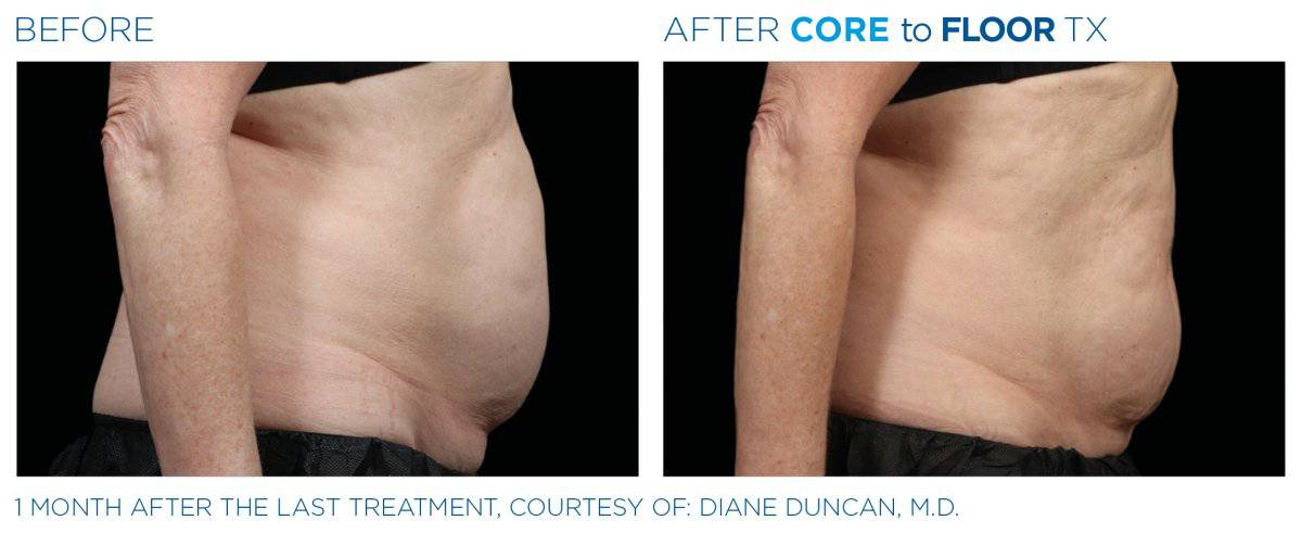 VIP BTL PassportProcedure - Renew Wellness & Aesthetics