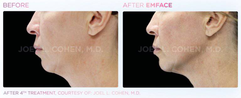 VIP BTL PassportProcedure - Renew Wellness & Aesthetics