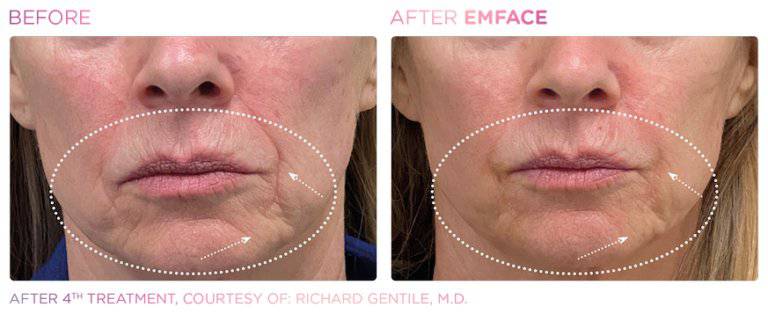 VIP BTL PassportProcedure - Renew Wellness & Aesthetics