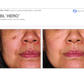 BBL Hero - Renew Wellness & Aesthetics 