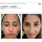 BBL Hero + MoxiProcedure - Renew Wellness & Aesthetics