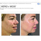 BBL Hero + MoxiProcedure - Renew Wellness & Aesthetics