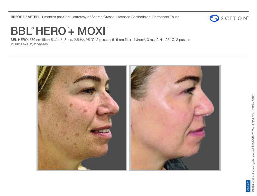 BBL Hero + MoxiProcedure - Renew Wellness & Aesthetics