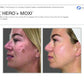 BBL Hero + MoxiProcedure - Renew Wellness & Aesthetics