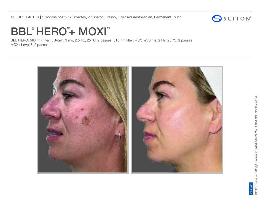 BBL Hero + MoxiProcedure - Renew Wellness & Aesthetics