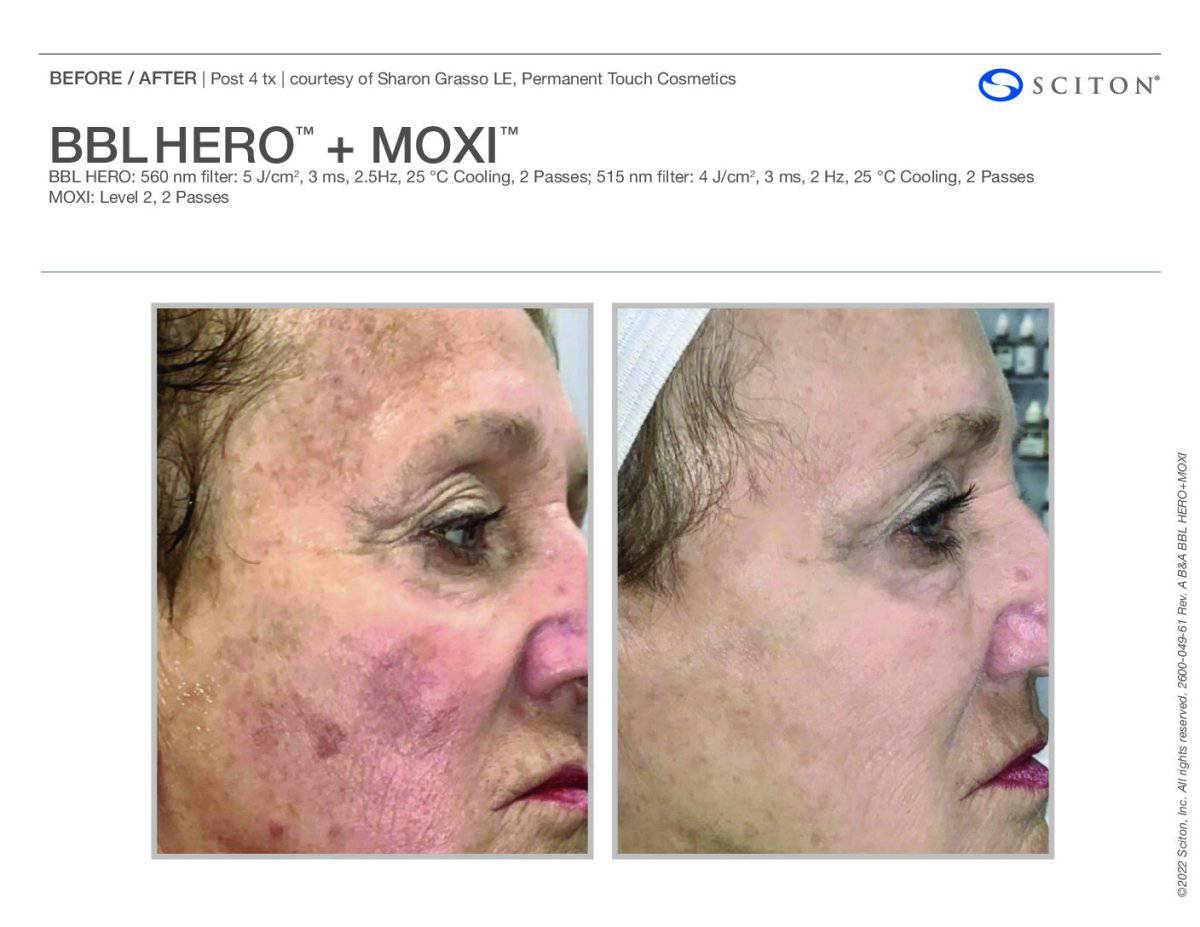 BBL Hero + MoxiProcedure - Renew Wellness & Aesthetics