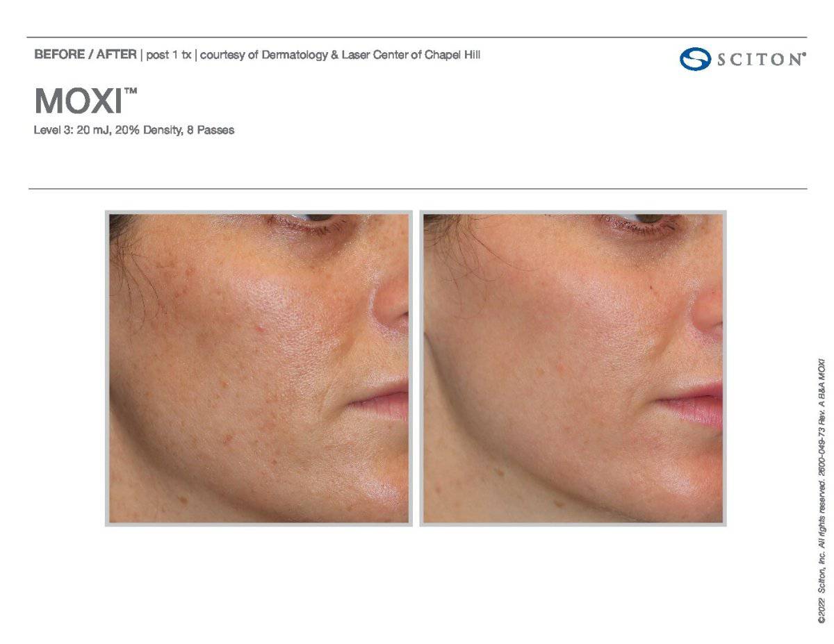 MoxiProcedure - Renew Wellness & Aesthetics