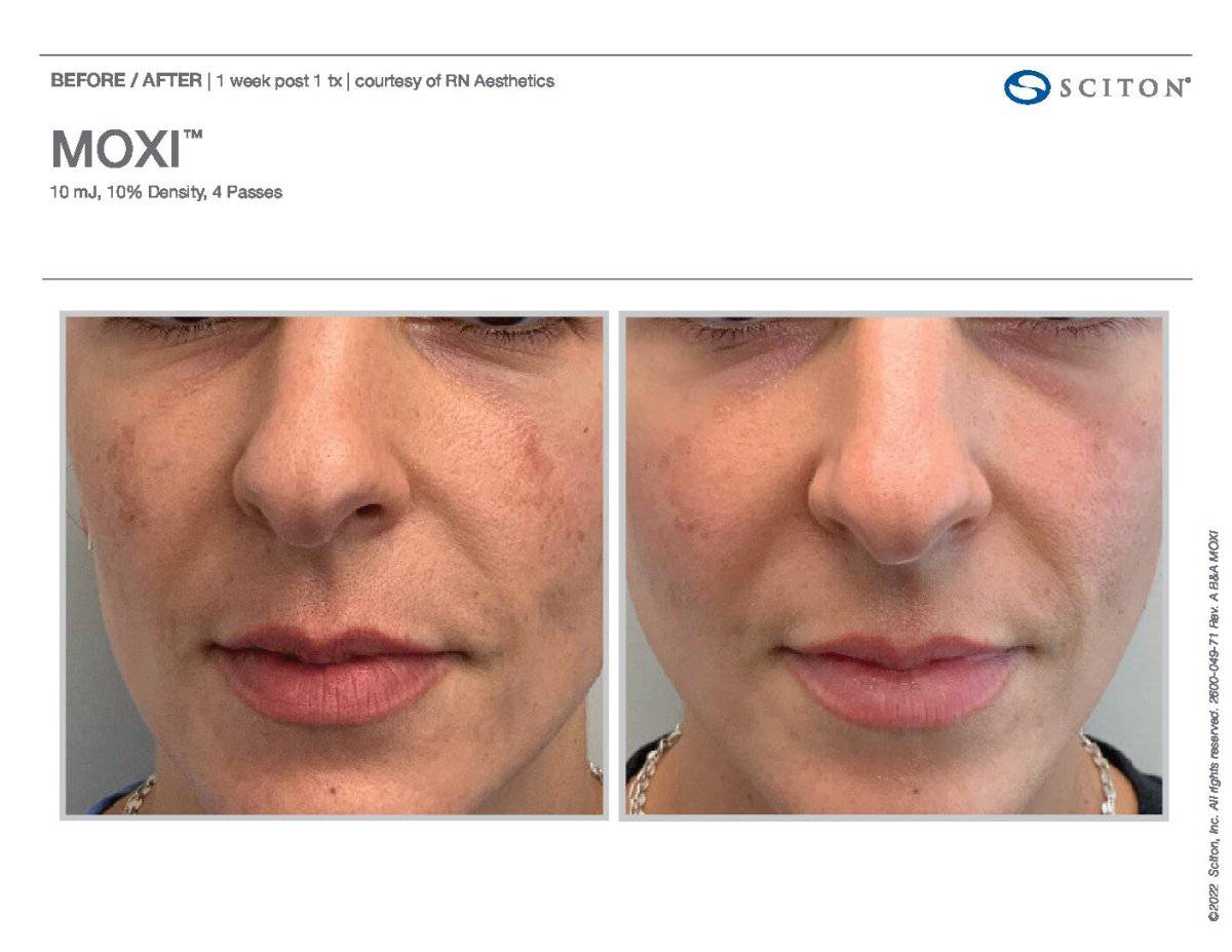 MoxiProcedure - Renew Wellness & Aesthetics