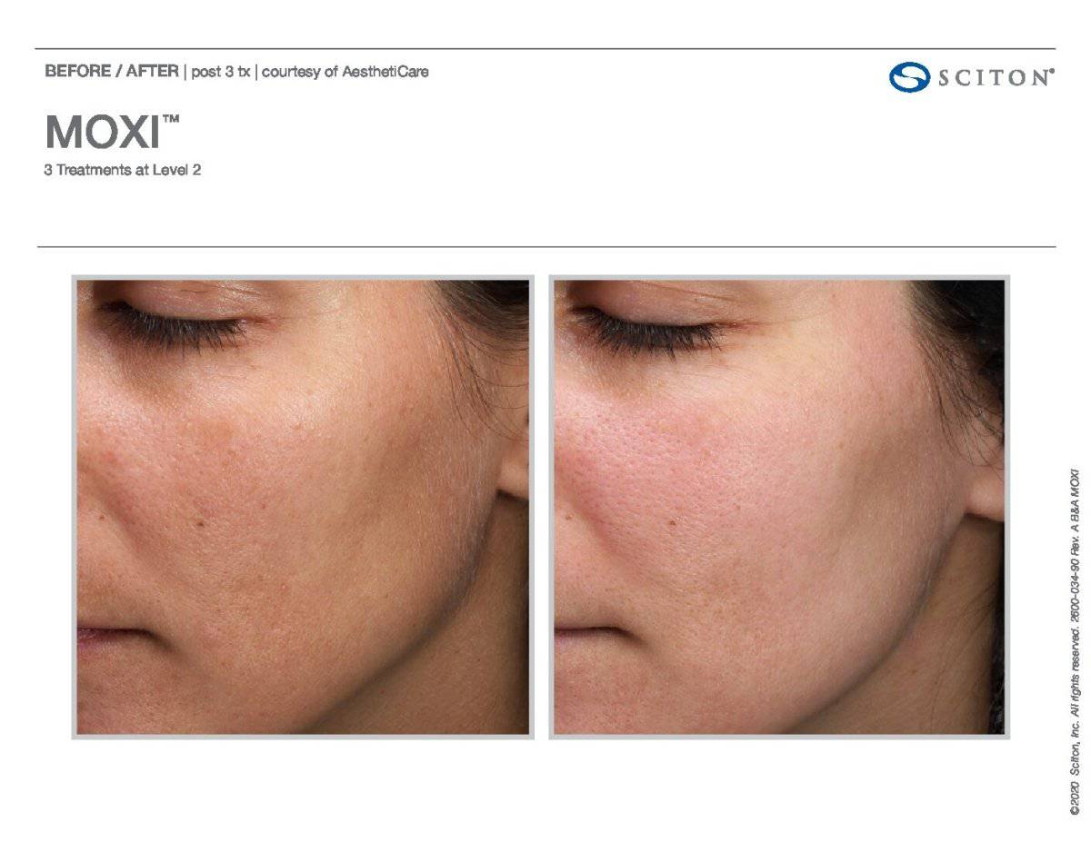 MoxiProcedure - Renew Wellness & Aesthetics