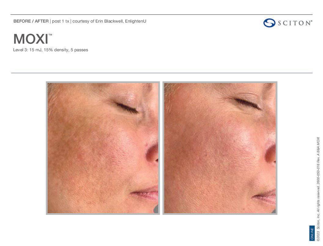 MoxiProcedure - Renew Wellness & Aesthetics