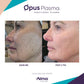 Opus Plasma Laser ResurfacingProcedure - Renew Wellness & Aesthetics