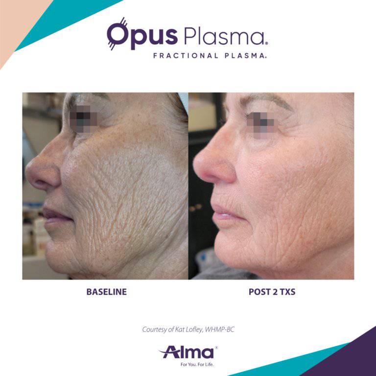 Opus Plasma Laser ResurfacingProcedure - Renew Wellness & Aesthetics