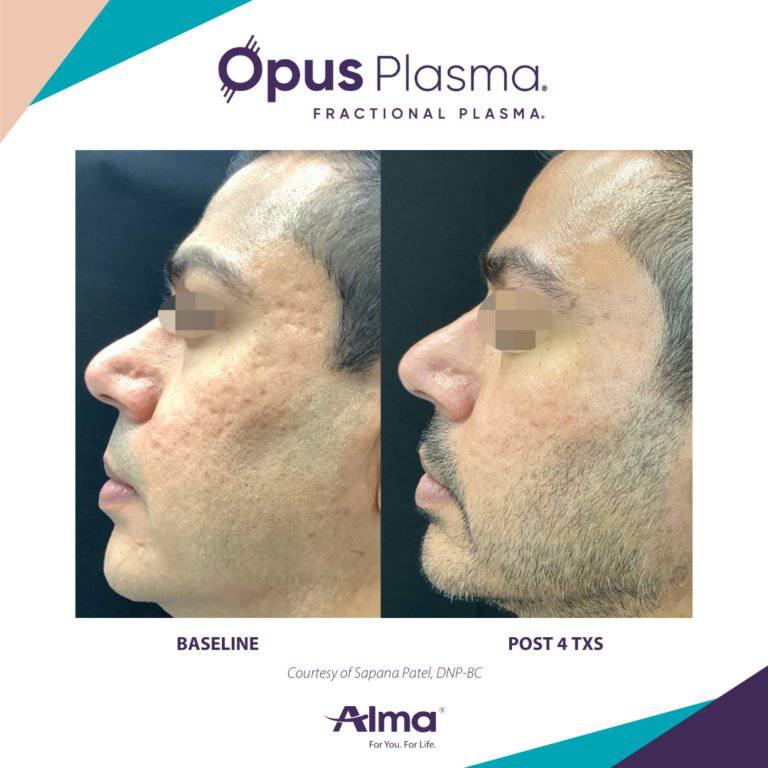 Opus Plasma Laser ResurfacingProcedure - Renew Wellness & Aesthetics