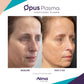 Opus Plasma Laser ResurfacingProcedure - Renew Wellness & Aesthetics