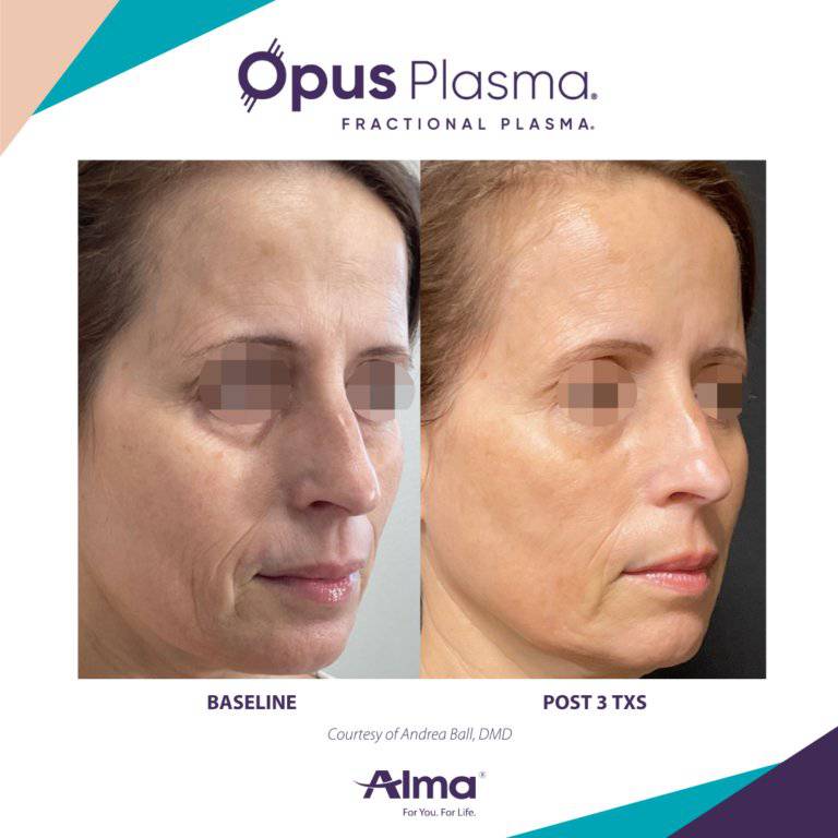 Opus Plasma Laser ResurfacingProcedure - Renew Wellness & Aesthetics