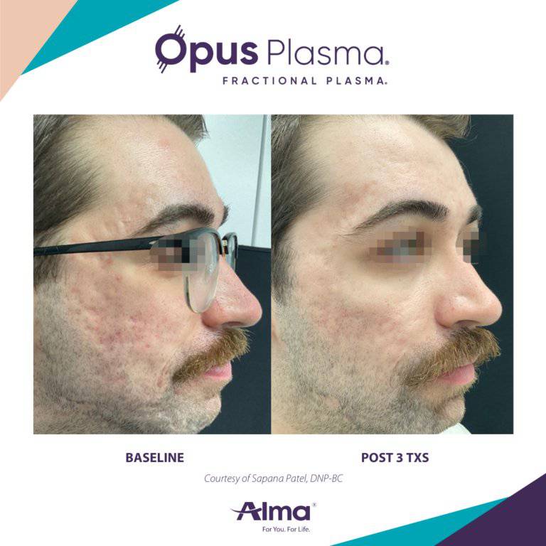 Opus Plasma Laser ResurfacingProcedure - Renew Wellness & Aesthetics