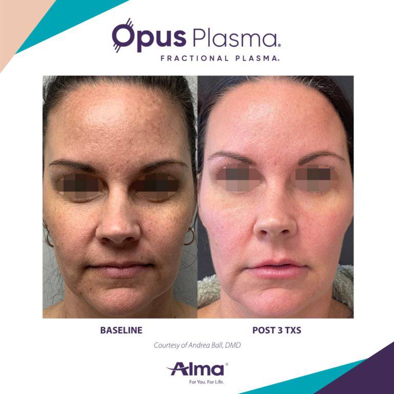 Opus Plasma Laser ResurfacingProcedure - Renew Wellness & Aesthetics