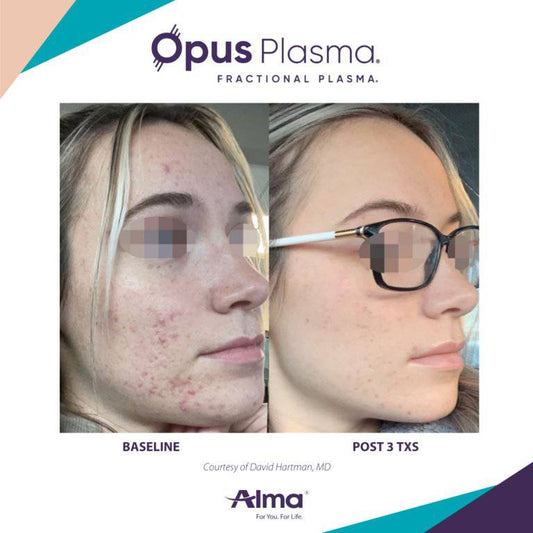Opus Plasma Laser Resurfacing