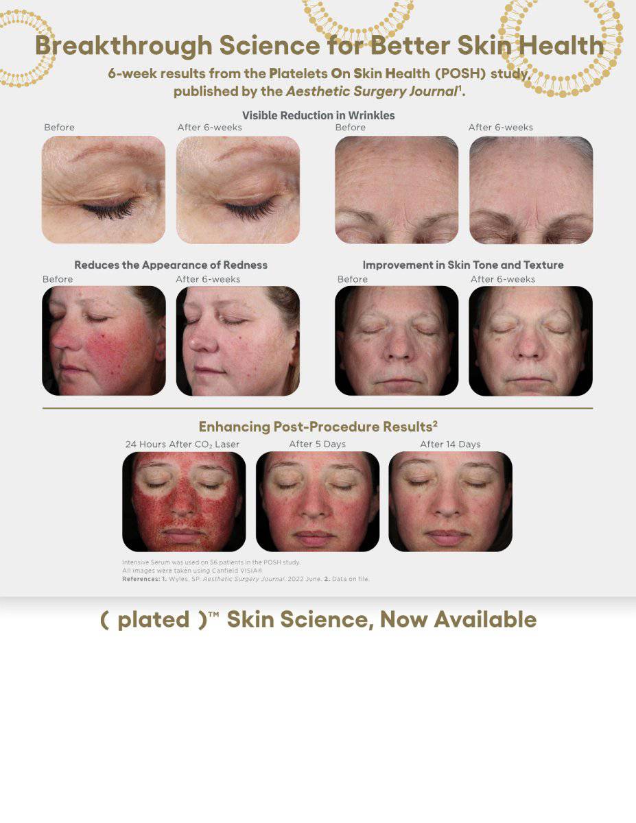 Microneedling with Exosomes or PRPProcedure - Renew Wellness & Aesthetics