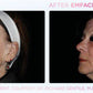 Emface Non - Surgical FaceliftProcedure - Renew Wellness & Aesthetics