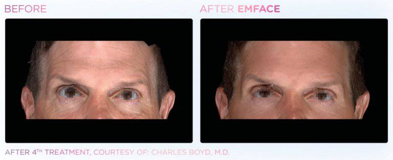 Emface Non - Surgical FaceliftProcedure - Renew Wellness & Aesthetics