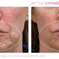 Emface Non - Surgical FaceliftProcedure - Renew Wellness & Aesthetics