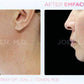 Emface Non - Surgical FaceliftProcedure - Renew Wellness & Aesthetics