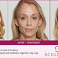 SculptraProcedure - Renew Wellness & Aesthetics