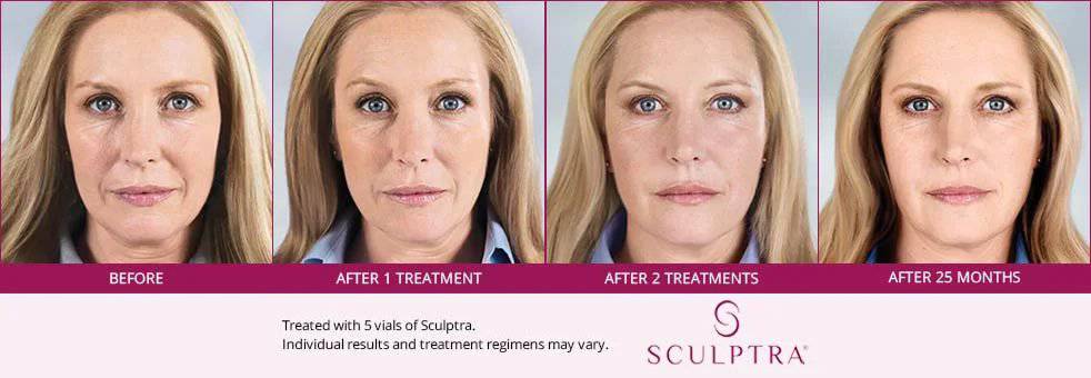 SculptraProcedure - Renew Wellness & Aesthetics