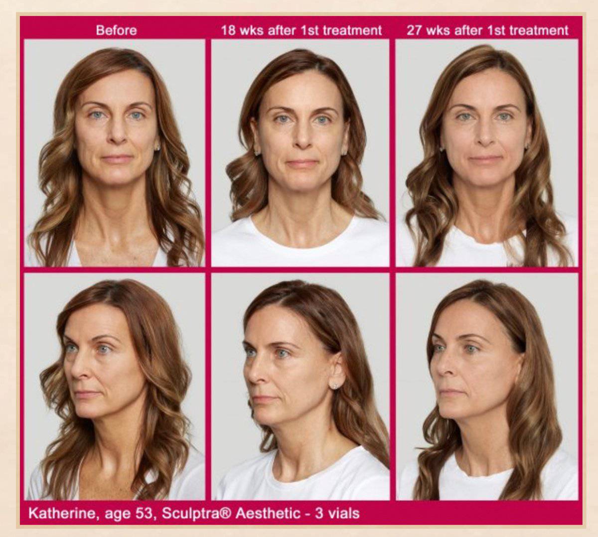 SculptraProcedure - Renew Wellness & Aesthetics