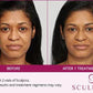 SculptraProcedure - Renew Wellness & Aesthetics